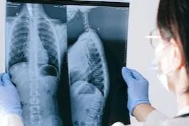 最新！阿根廷突发不明原因肺炎，6例双侧肺炎，其中2人死亡！