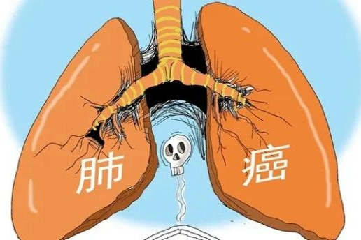 非小细胞肺癌靶向治疗！国内上市的6款ALK抑制剂疗效如何？医保？
