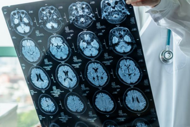 重磅！阿尔茨海默病新药获FDA委员会全票支持，股票大涨停牌！