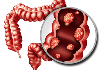 2025年ESMO妇科癌症大会（ESMO&GCC）